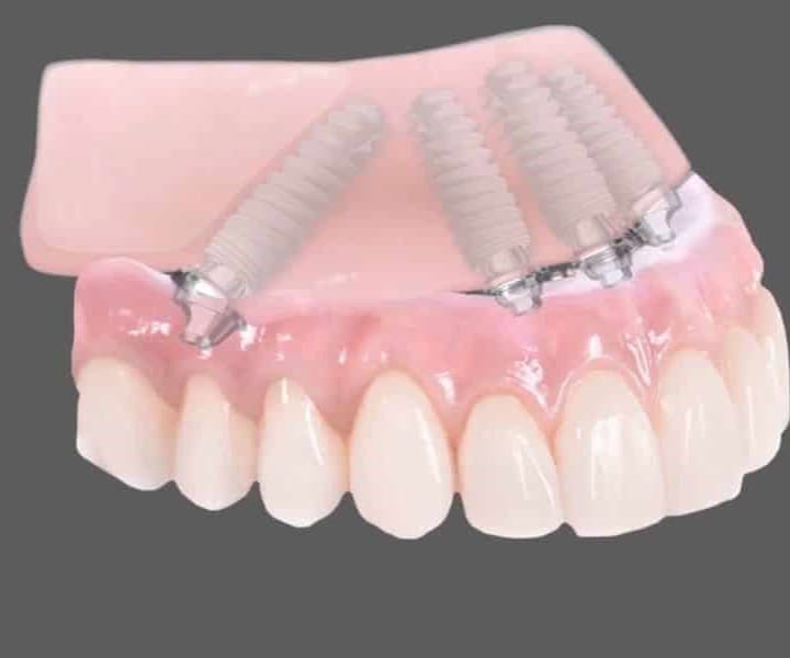 dental, dentist, dental clinic, dental bridges, dental cosmetic, dental crown, dental veneer, implants, invisalign, bangkok, sukhumvit, Thailand