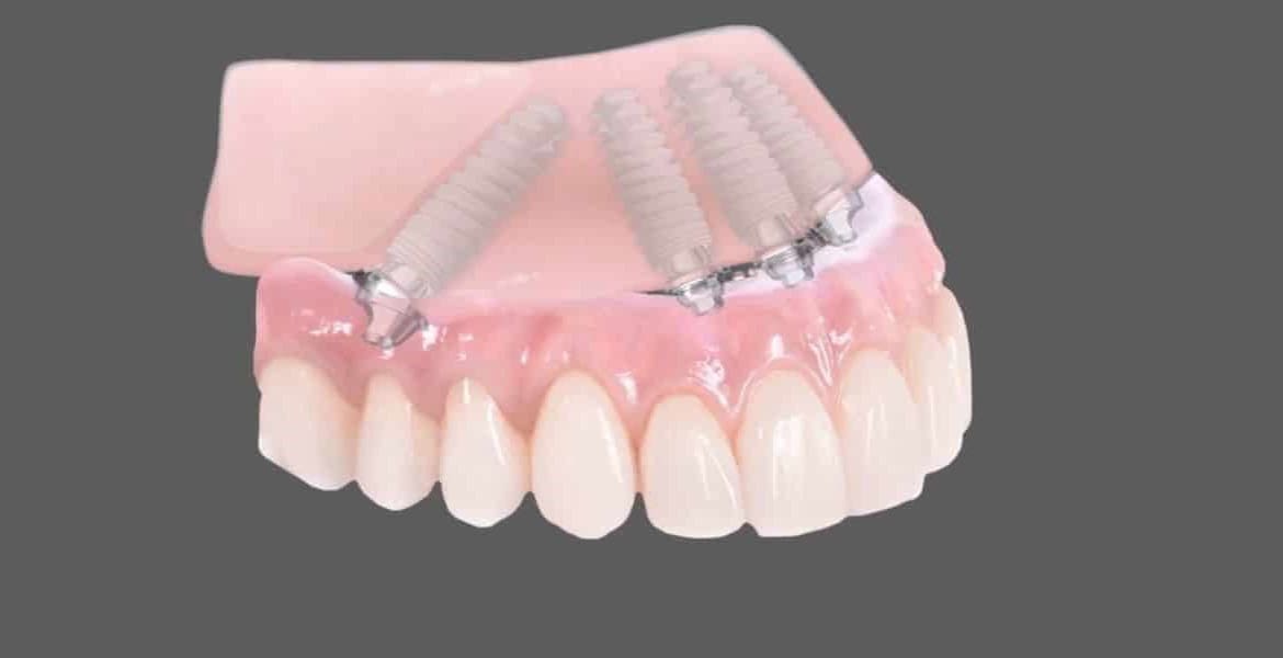 All On 4 Teeth Implants - The Facts