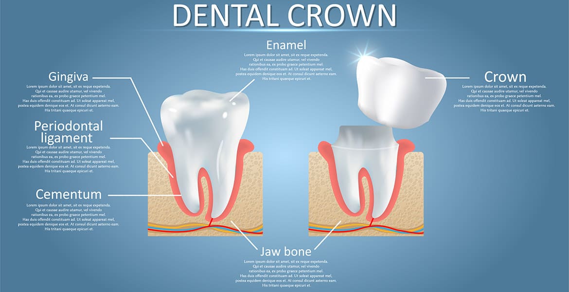Dental Crowns For Your Smile
