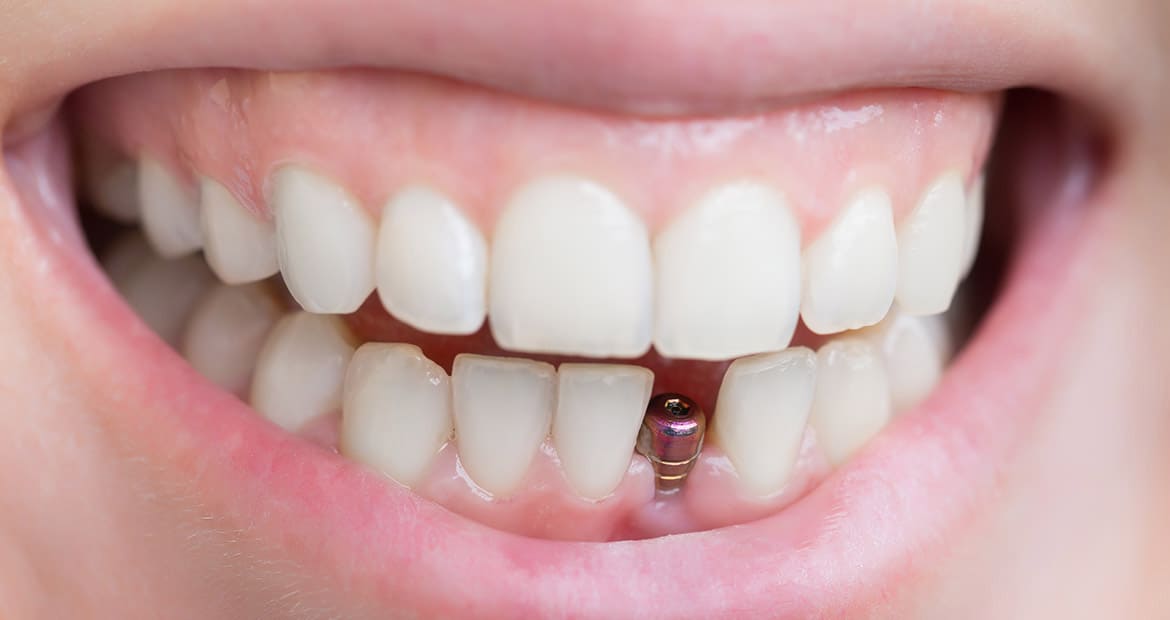 Dental Bridges - Dental Restoration for Teethless Conditions