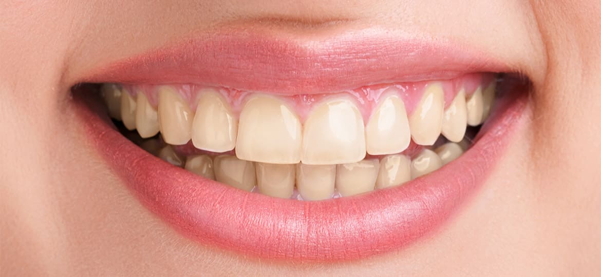 How to Get Rid of Blue Teeth - Here Is Some Teeth Whitening Tips