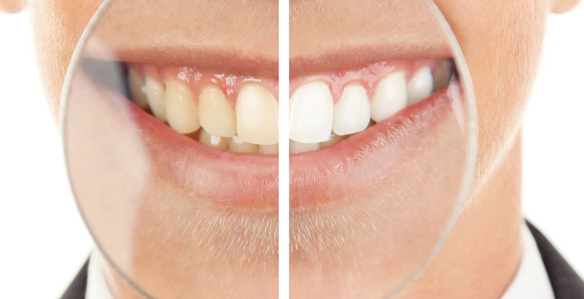 Teeth Whitening Costs