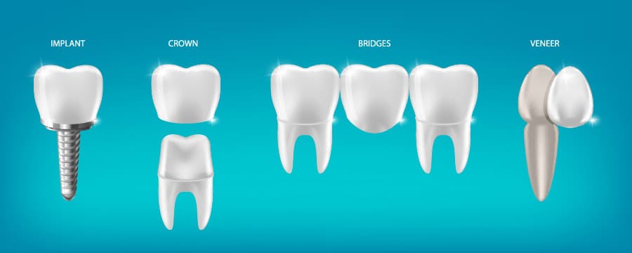The Benefits of Dental Crowns Over Dental Bridges and Inlays