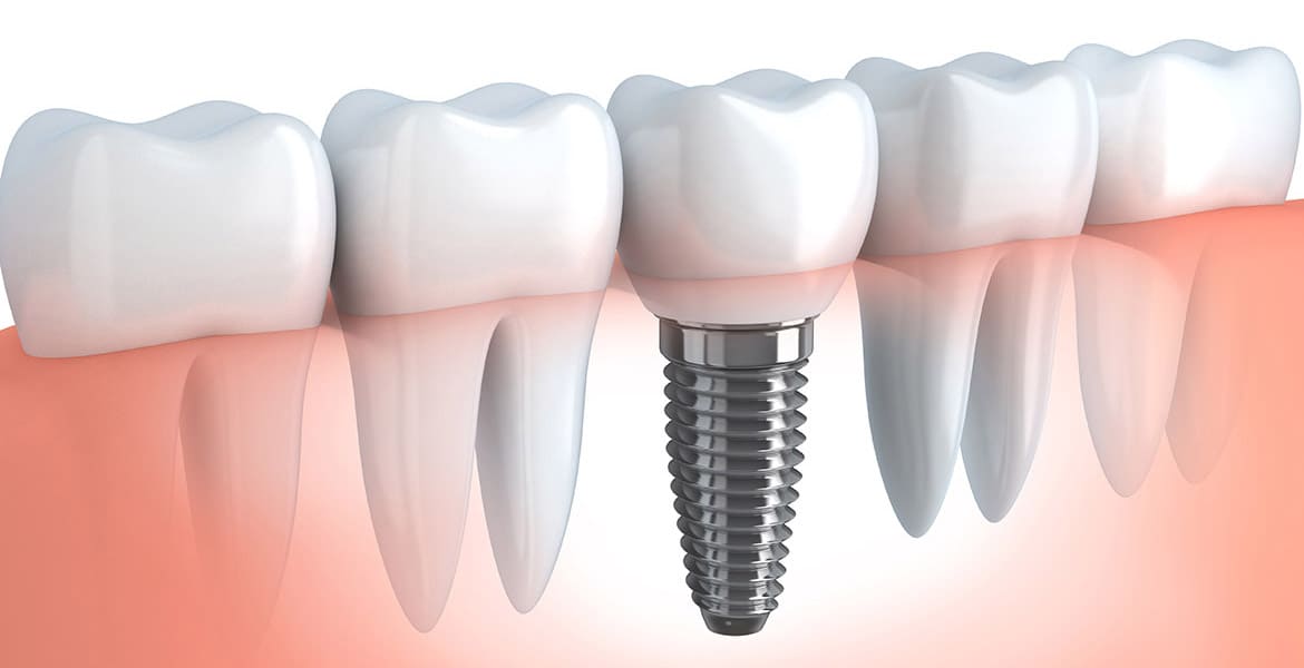 What Are Dental Implants and How Can They Help Improve Your Oral Health