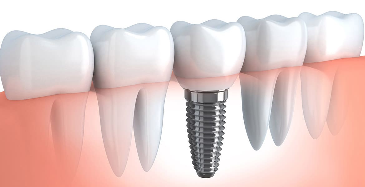 What Are Dental Implants and How Can They Help Improve Your Oral Health