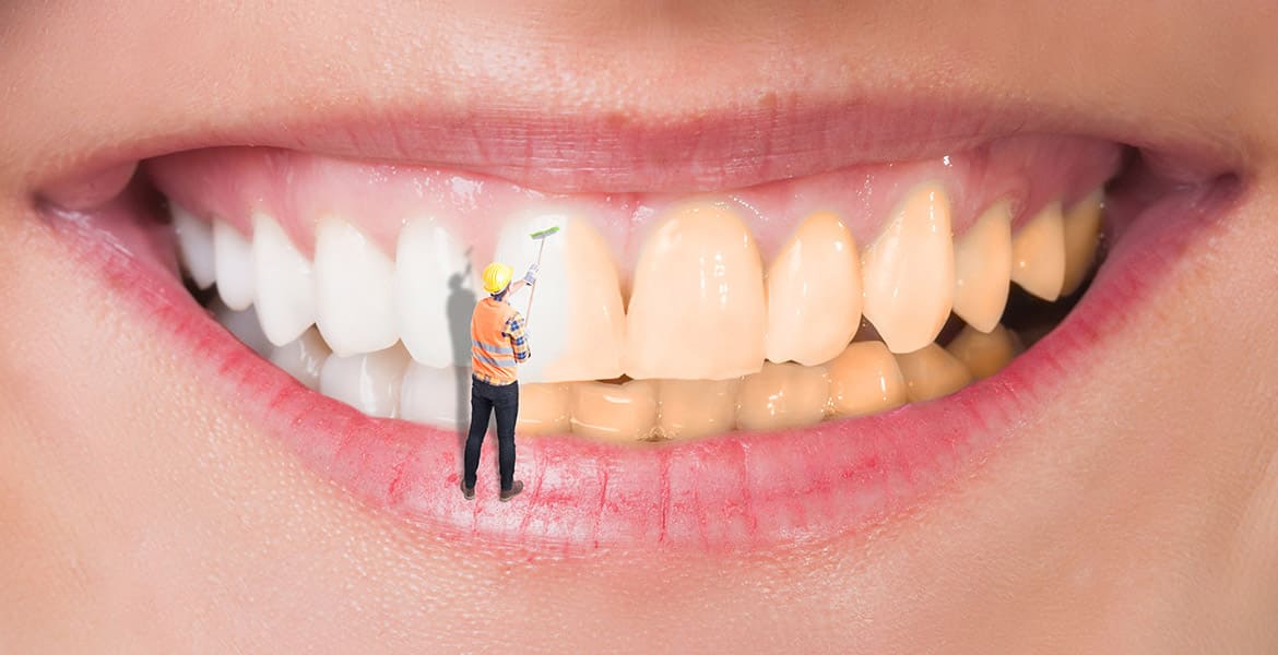 What Are the Different Teeth Whitening Solutions Available in the Market?