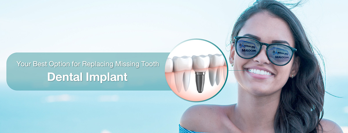 Your Best Option for Replacing Missing Tooth