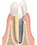 Single Tooth Dental Implant