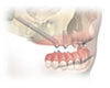 2 Zygoma™ + 2 Dental Implants