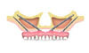 4 Zygoma™ Implants