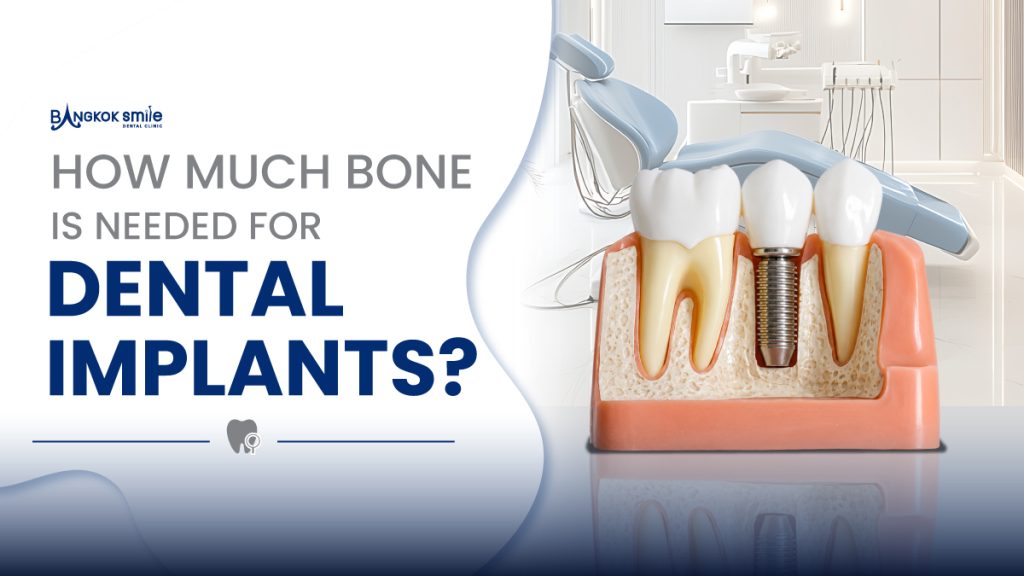 how much bone is needed for dental implants