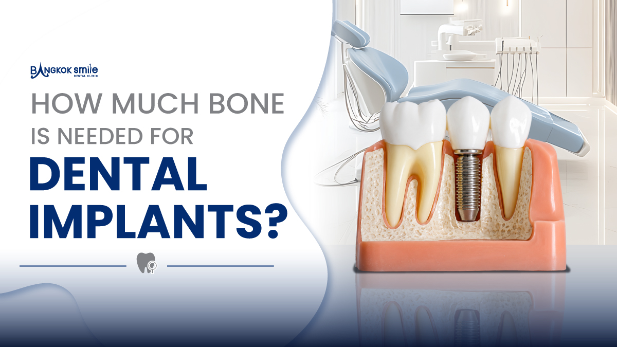 how much bone is needed for dental implants